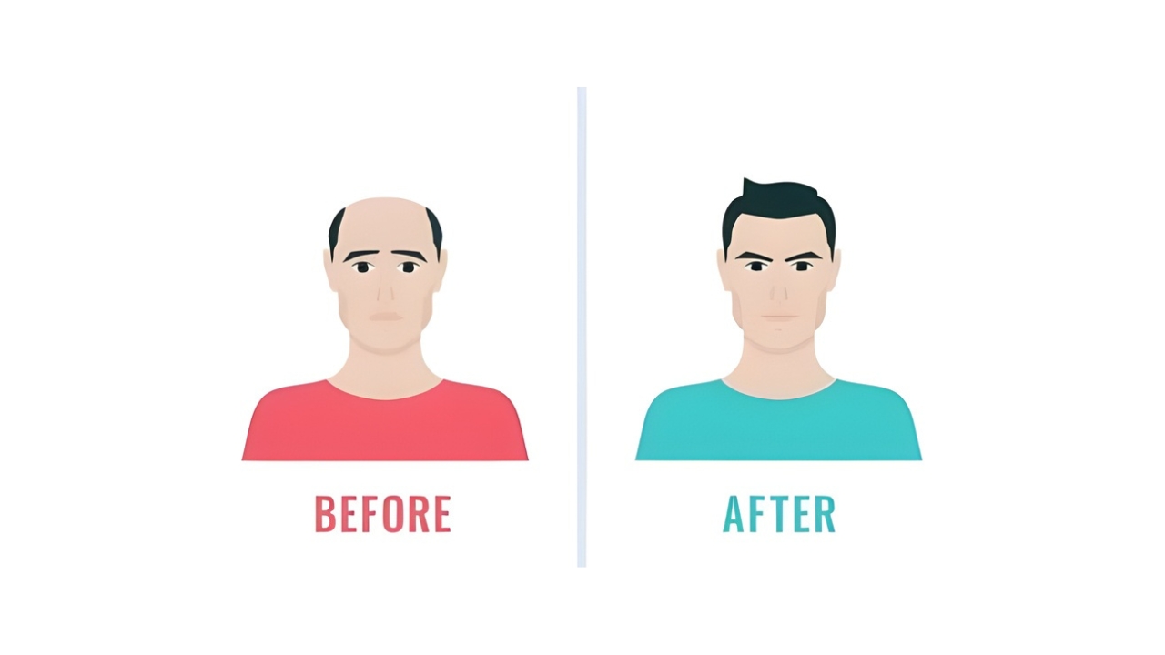 Hair Transplant Procedure and Results